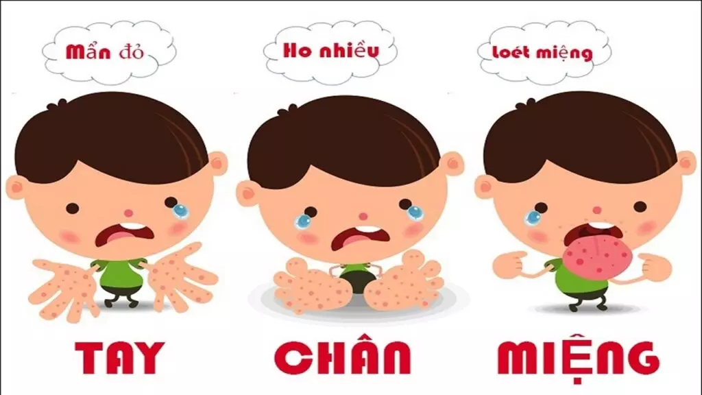 Bệnh tay chân miệng dễ lây nhiễm ở trẻ